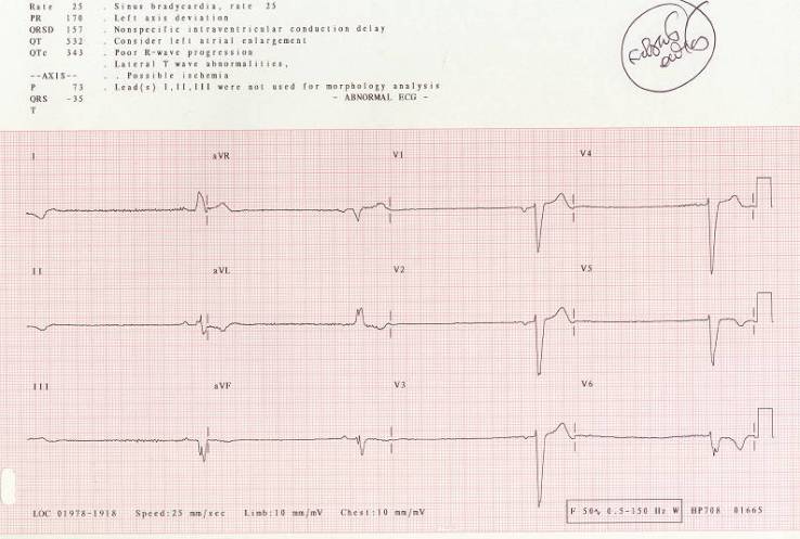 ECG_CT_NSR